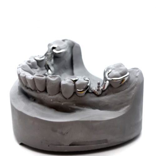 3D printed partial (CoCr) by 2onelab