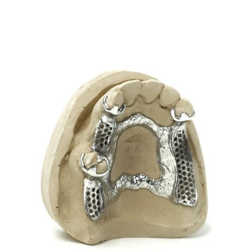 3D printed partial (CoCr) by 2onelab
