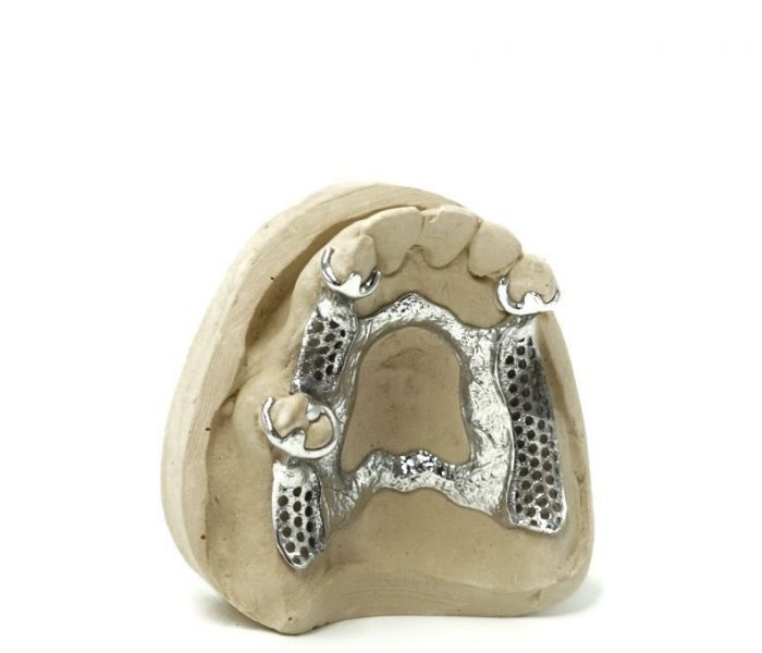 3D printed partial (CoCr) by 2onelab