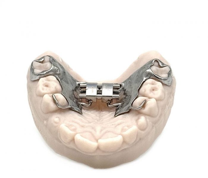 3D printed RPE (Stainless Steel) by 2onelab