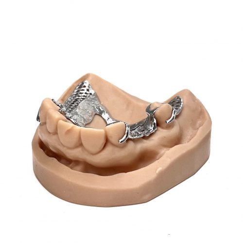 3D printed partial (CoCr) by 2onelab