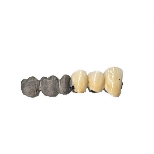 Partially ceramic coated bridge by 2onelab