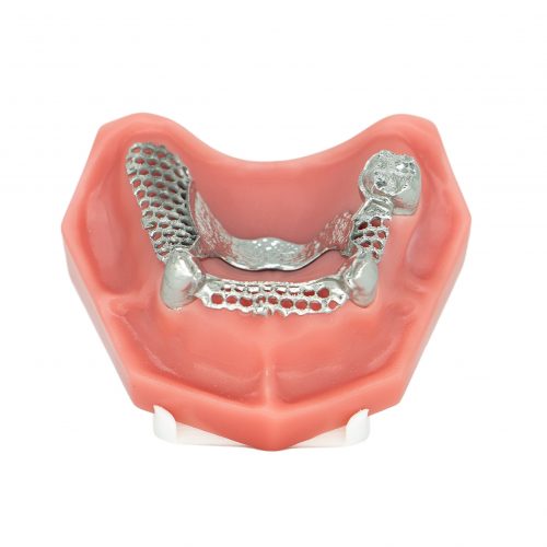 Polished telescopic RPD (CoCr)