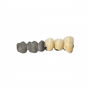 Partially ceramic coated bridge by 2onelab