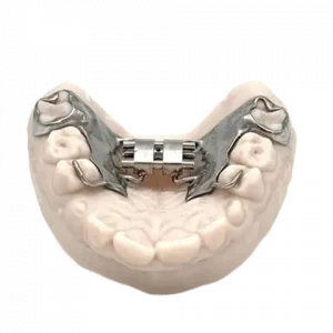 3D printed RPE (Stainless Steel) with welded expander by 2onelab