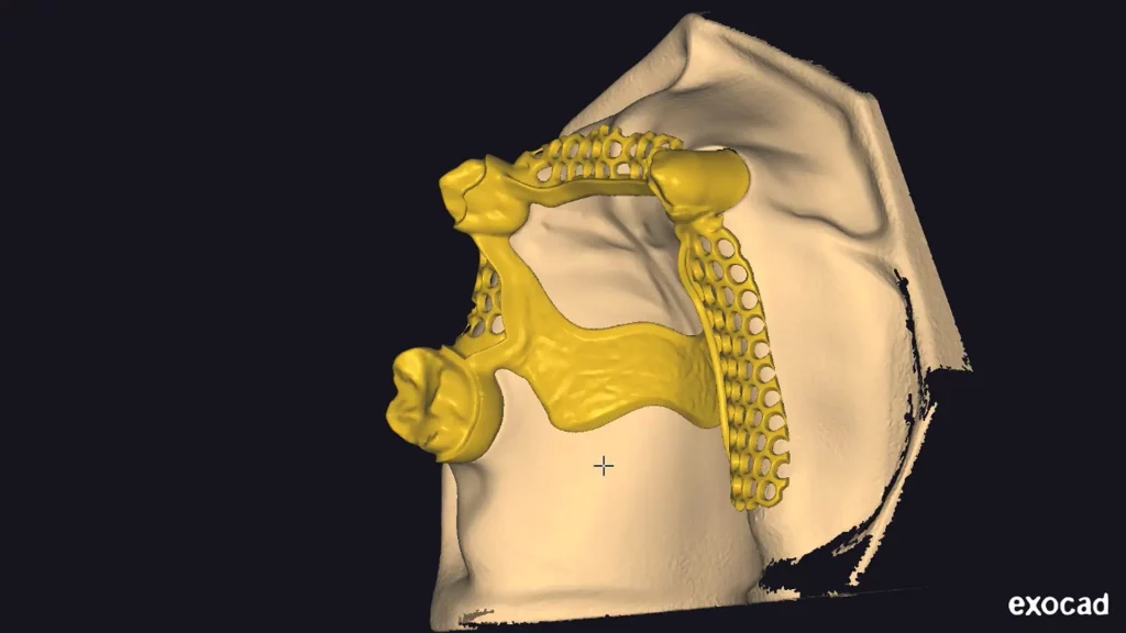 CAD-Exocad graphic