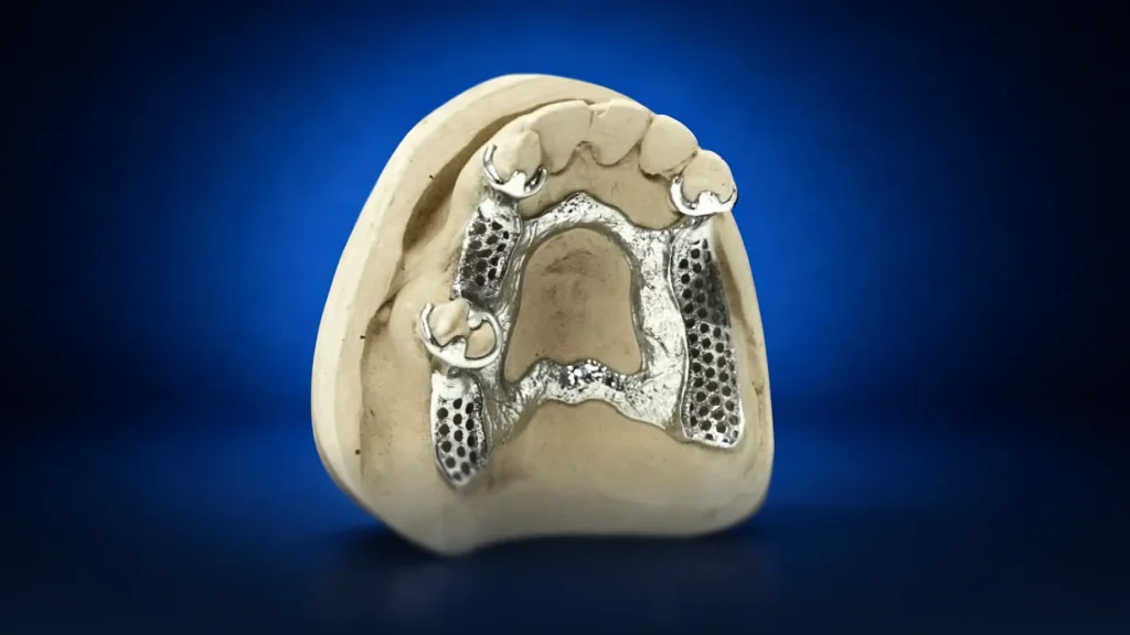 Metal partial dentures - dental solutions